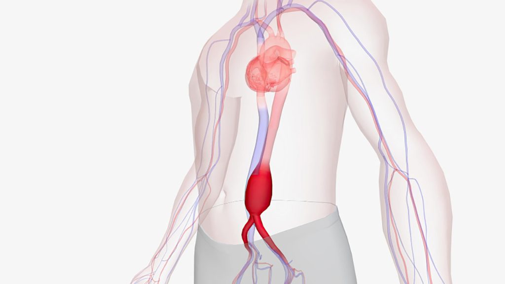 Que es un aneurisma aortico - Cirugí­a Cardíaca Hospital Universitario ...